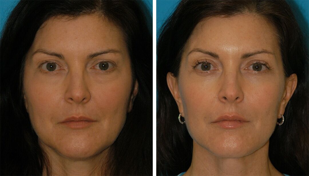 Non-Surgical Skin Tightening | Princeton, NJ | Brunner MD