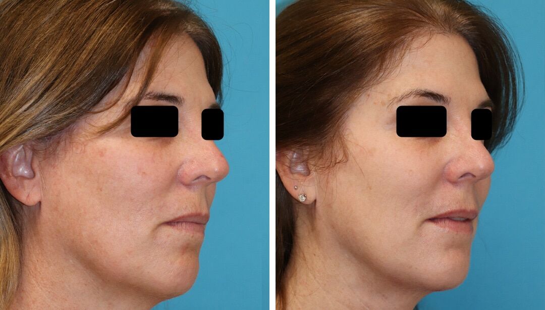Non-Surgical Skin Tightening | Princeton, NJ | Brunner MD